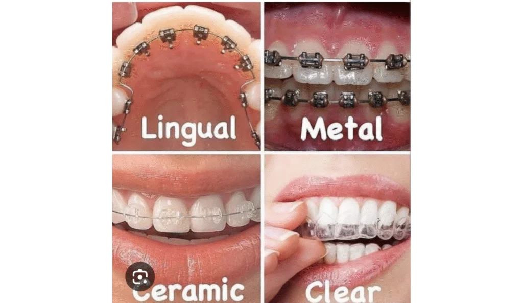 Brackets variety